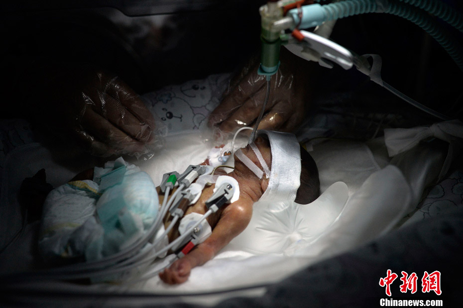 أصغر طفل خديج يزن 0.66 كيلوغراما في الصين