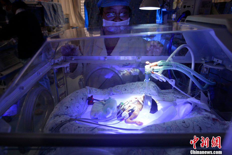 أصغر طفل خديج يزن 0.66 كيلوغراما في الصين