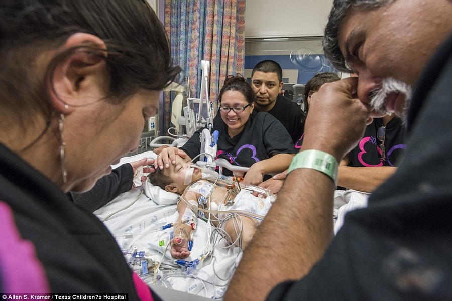 طفلتان سياميتان (10 أشهر) تجتازان بنجاح أول عملية من نوعها لفصلهما