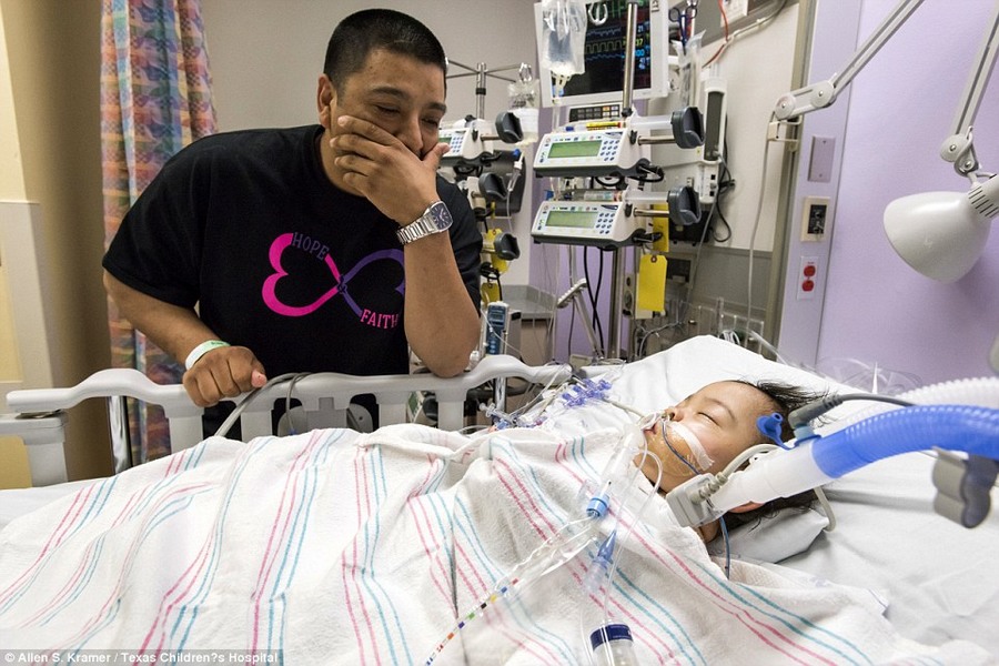 طفلتان سياميتان (10 أشهر) تجتازان بنجاح أول عملية من نوعها لفصلهما