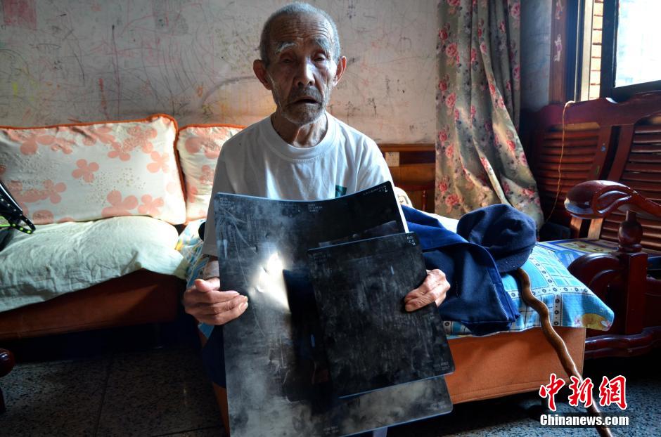 جندي سابق عمره 94 عاما إكتشف رصاصة في جسمه أصابته قبل ستين سنة