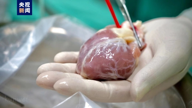 لأول مرة في آسيا..أطباء صينيون يزرعون قلبا لرضيعة لم تتم الشهرين